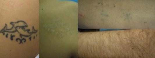 eliminacion de tatuajes con láser antes y después