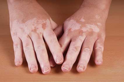 vitiligo en dermitek
