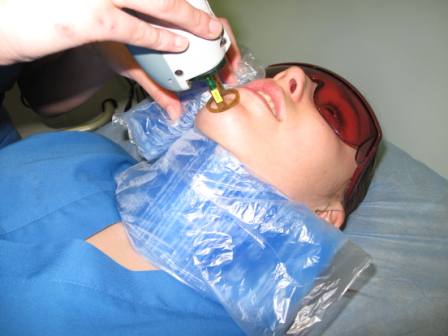 Protocolo de depilacion laser facial en mujeres