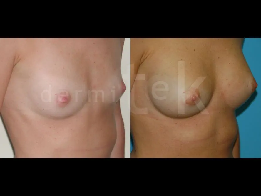 Cirugía de mamas. Clínica Dermitek de Bilbao