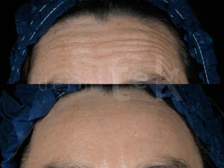 Antes y después de un tratamiento con bótox