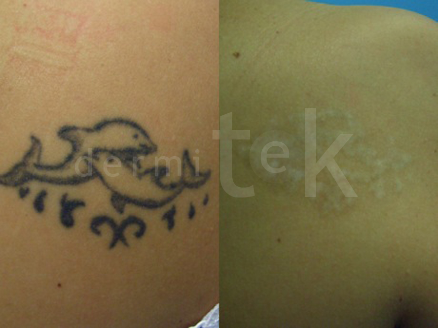 aritmética jugo Mujer joven Eliminar Tatuajes Con Láser. Clínica Dermitek,Bilbao