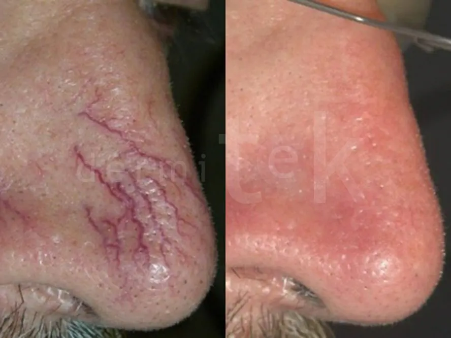 fotos antes y después tratamiento de cuperosis