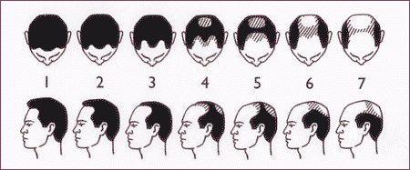 Alopecia en los hombres. Escala de Hamilton