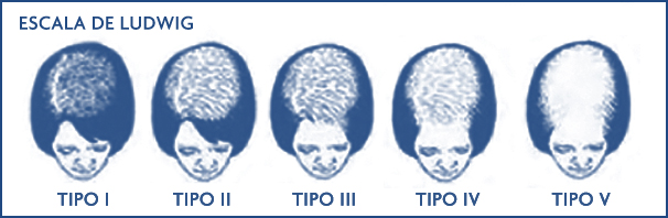 Alopecia en las mujeres. Escala de ludwig