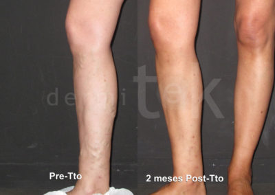 Resultados tras tratamiento varices en Dermitek en Bilbao.