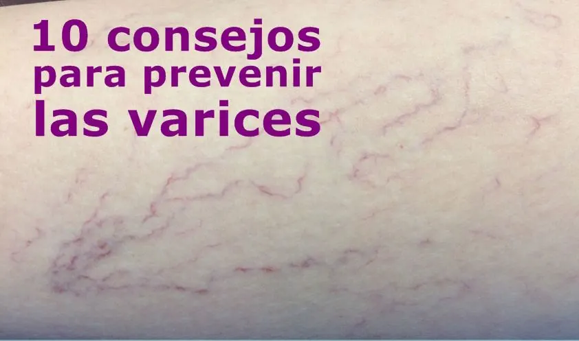 consejos para la prevención de varices dermitek