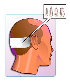 extracción del pelo para implante