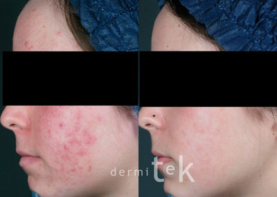 tratamiento laser marcas de acné