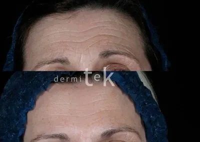 Botox facial en bilbao