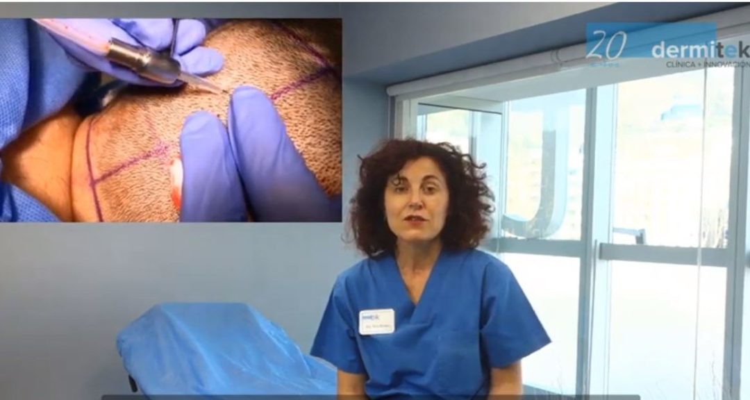 vídeo sobre el trasplante capilar en Dermitek