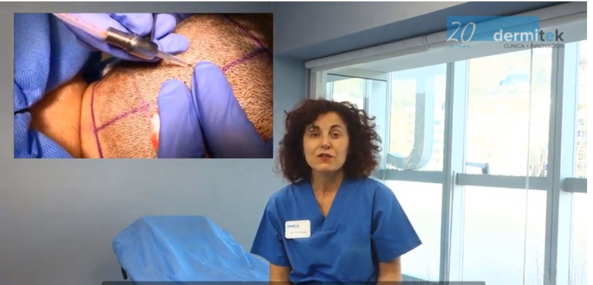 vídeo sobre el trasplante capilar en Dermitek