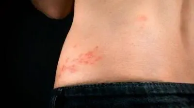Herpes zóster – Consulta de dermatología online