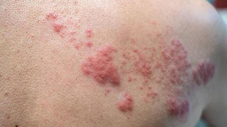 herpes zoster web 3