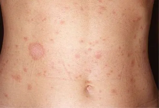 Pitiriasis rosada de Gibert – Consulta de dermatología